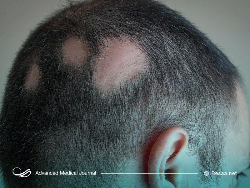 ریزش مو ارثی