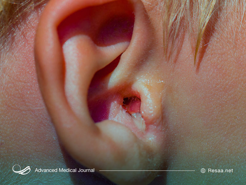 صدابیزاری یا میسوفونیا