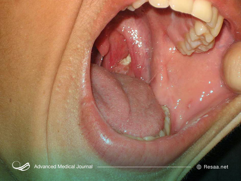 خراشیدگی گلو