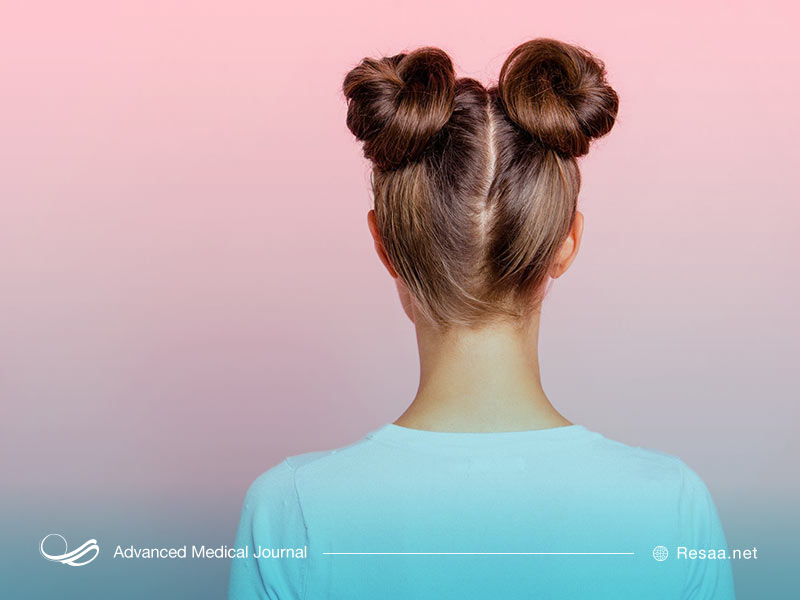 بلفاروپلاستی