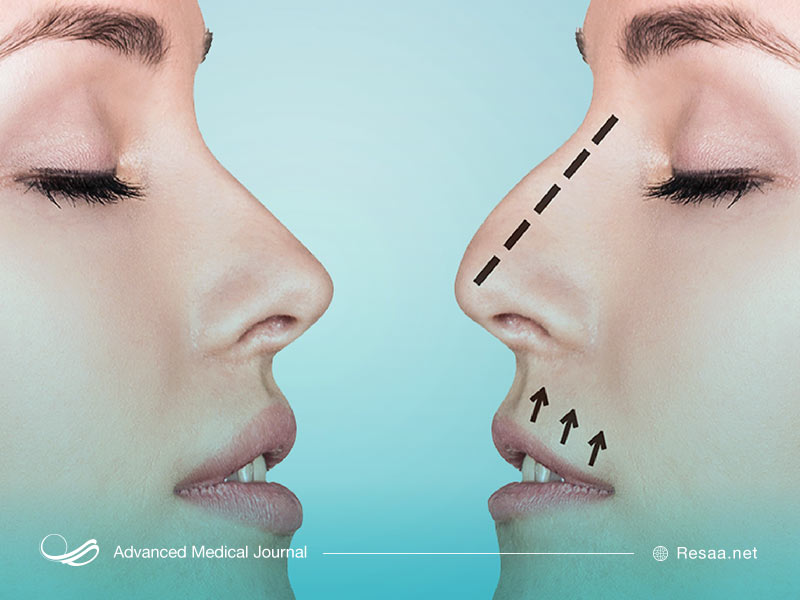 التهاب مخاط بینی