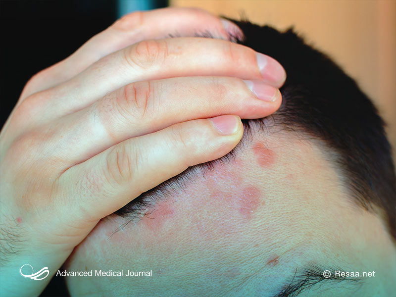 آکنه، یک بیماری مزمن و التهابی پوست است