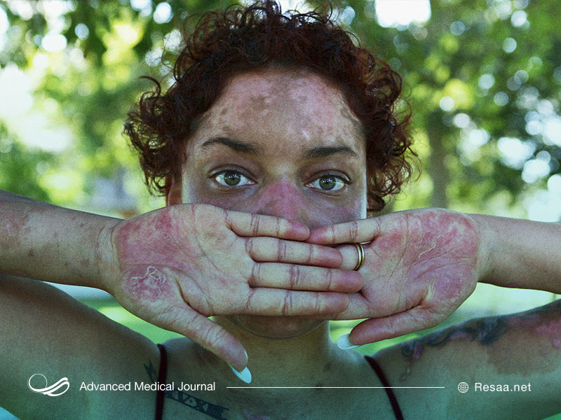 لوپوس گاها باعث ایجاد لخته خون در سراسر بدن شما می‌شود.