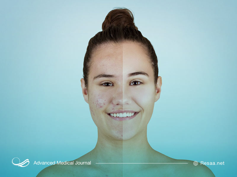 عوارض جانبی راکوتان چیست؟