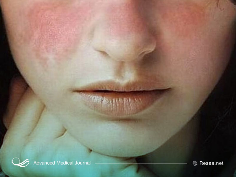 "آیا علامتی که من تجربه می‌کنم به نوعی با بیماری لوپوس مرتبط است؟"