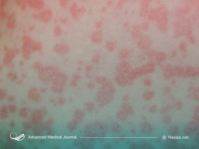 عوارض جانبی آموکسی سیلین چیست؟