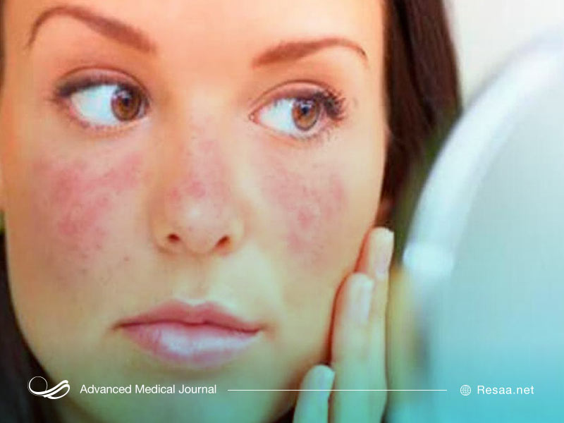 مسیر دشوار تشخیص بیماری لوپوس