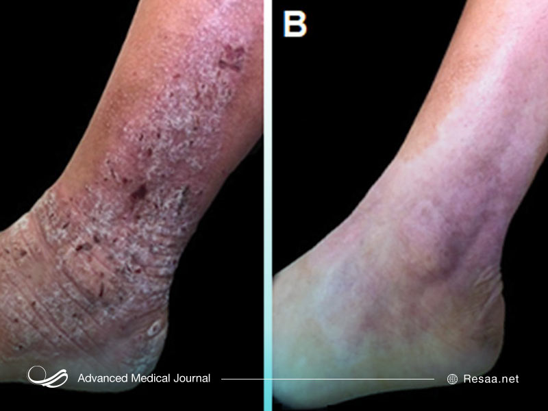 عوارض جانبی بتامتازون