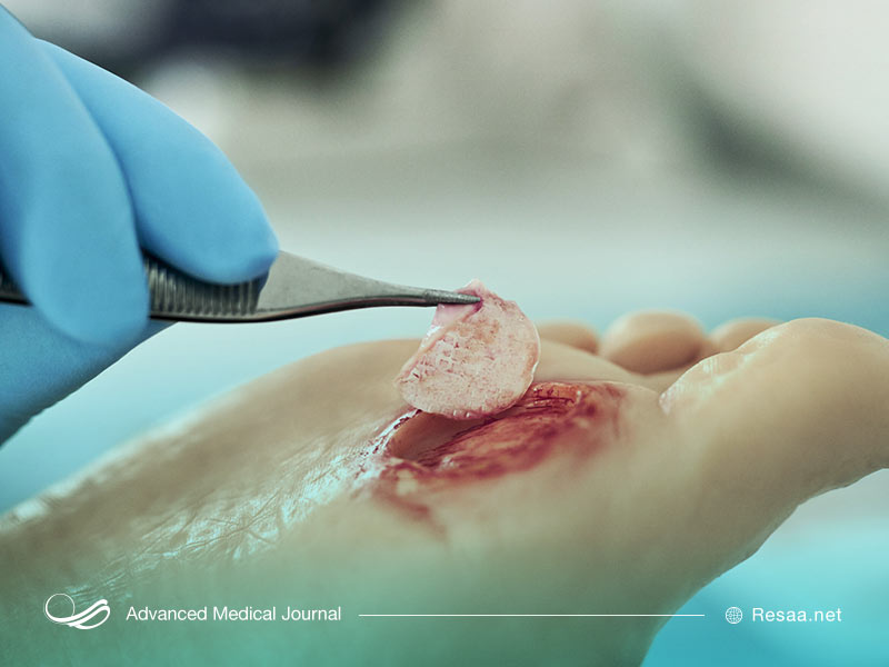 تصویربرداری پرفیوژن برای PAD و زخم پای دیابتی