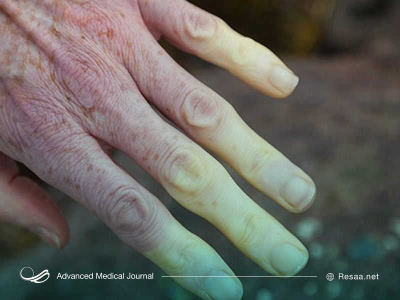 چهره‌های متعدد لوپوس