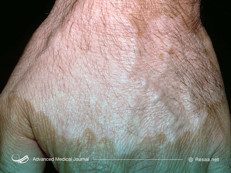 داروهایی بر بتامتازون