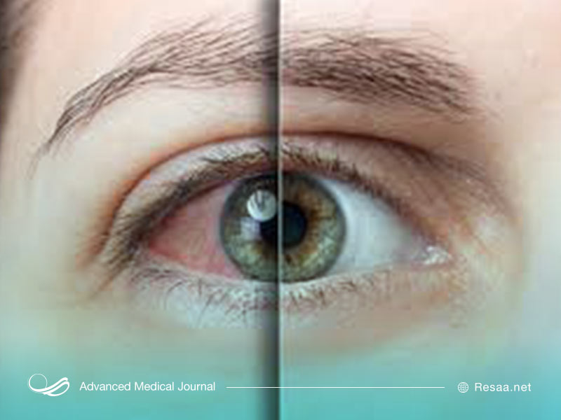 خشکی چشم ممکن است هر کسی را تحت تاثیر قرار دهد.