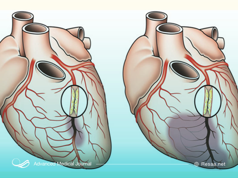 چه چیزی باعث بروز و ابتلا به بیماری عروق کرونر می‌شود؟
