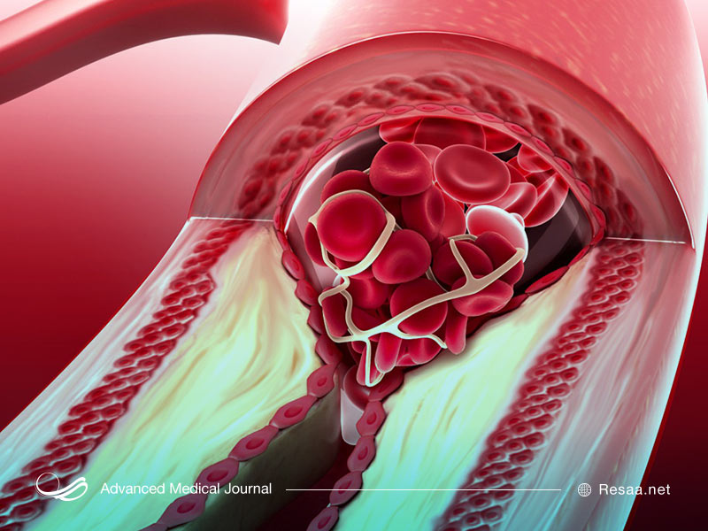 ایسکمی چیست؟