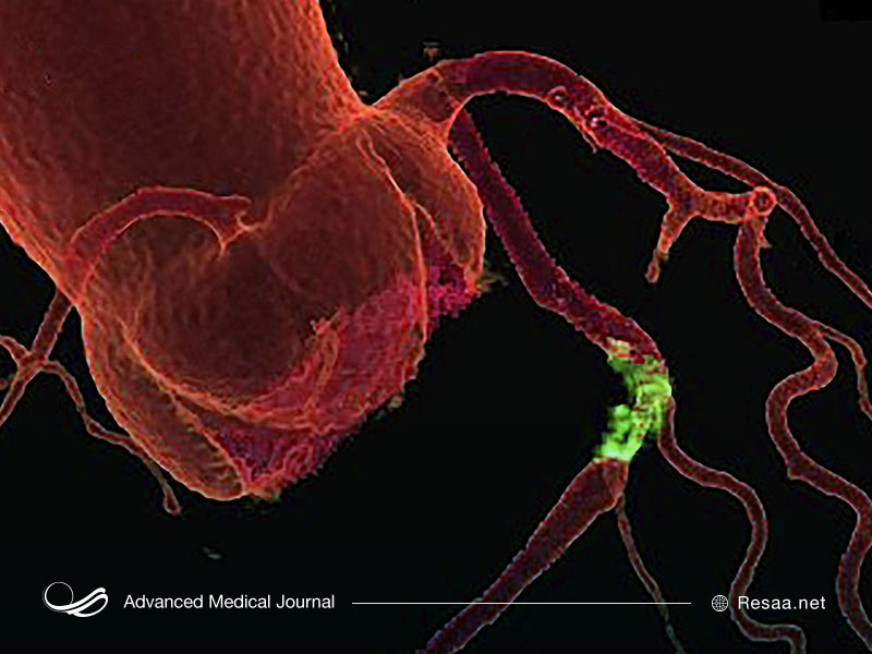 چگونه باید بیماری عروق کرونر را درمان کنید؟